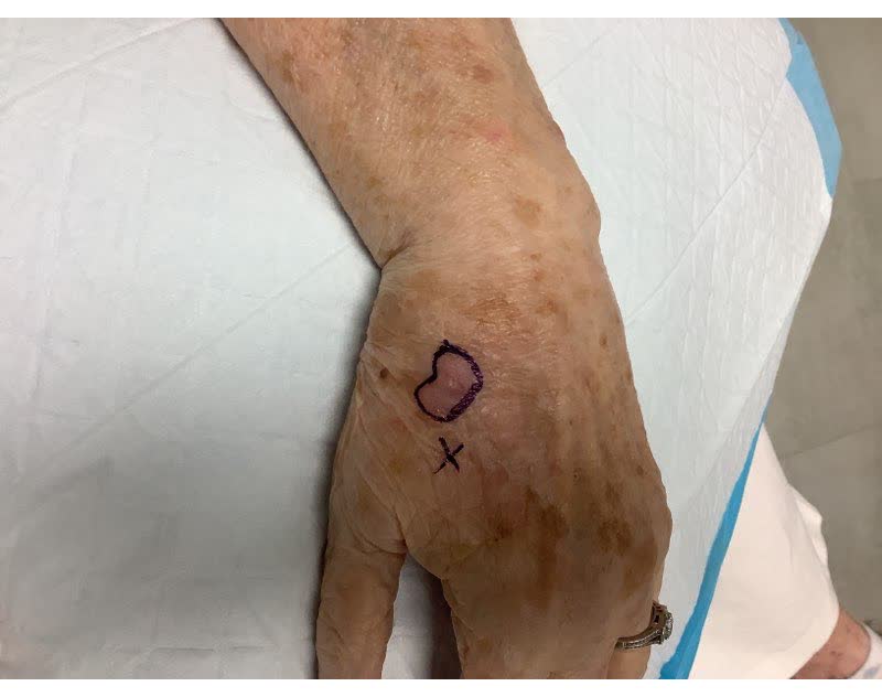 Mohs case 14 &mdash; Before: squamous cell carcinoma on the left hand