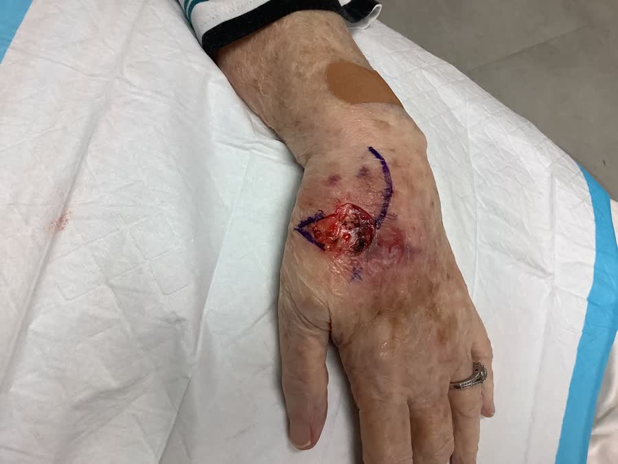 Mohs case 14 &mdash; After cancer removal: squamous cell carcinoma on the left hand
