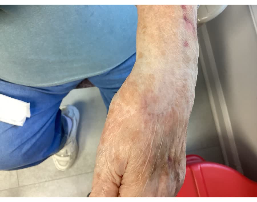 Mohs case 14 &mdash; Healed: squamous cell carcinoma on the left hand