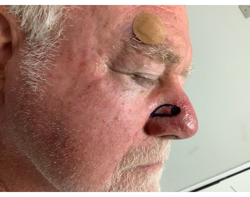 Mohs case 15 &mdash; Before - close-up: basal cell carcinoma on the nasal dorsum