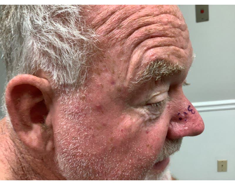 Mohs case 15 &mdash; Before: basal cell carcinoma on the nasal dorsum