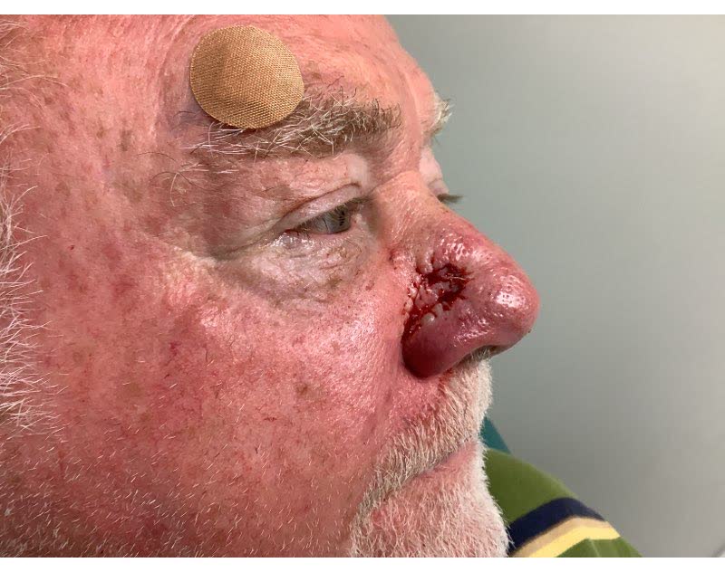 Mohs case 15 &mdash; After cancer removal: basal cell carcinoma on the nasal dorsum