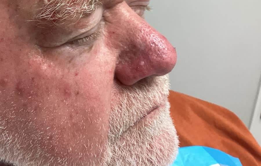 Mohs case 15 &mdash; Healed: basal cell carcinoma on the nasal dorsum