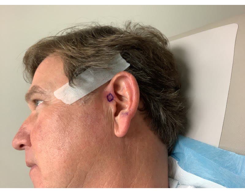 Mohs case 16 &mdash; Before: basal cell carcinoma on the left ear and sideburn