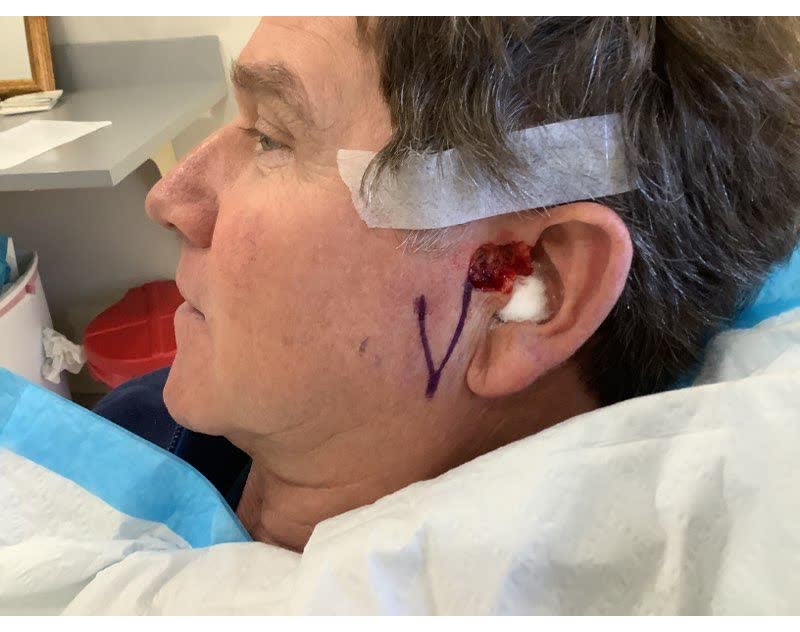 Mohs case 16 &mdash; After cancer removal: basal cell carcinoma on the left ear and sideburn