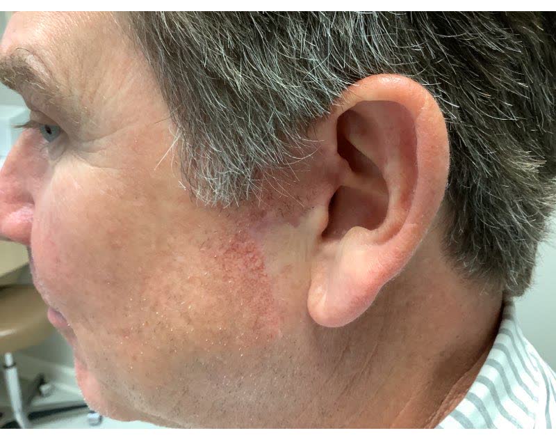 Mohs case 16 &mdash; Healed: basal cell carcinoma on the left ear and sideburn