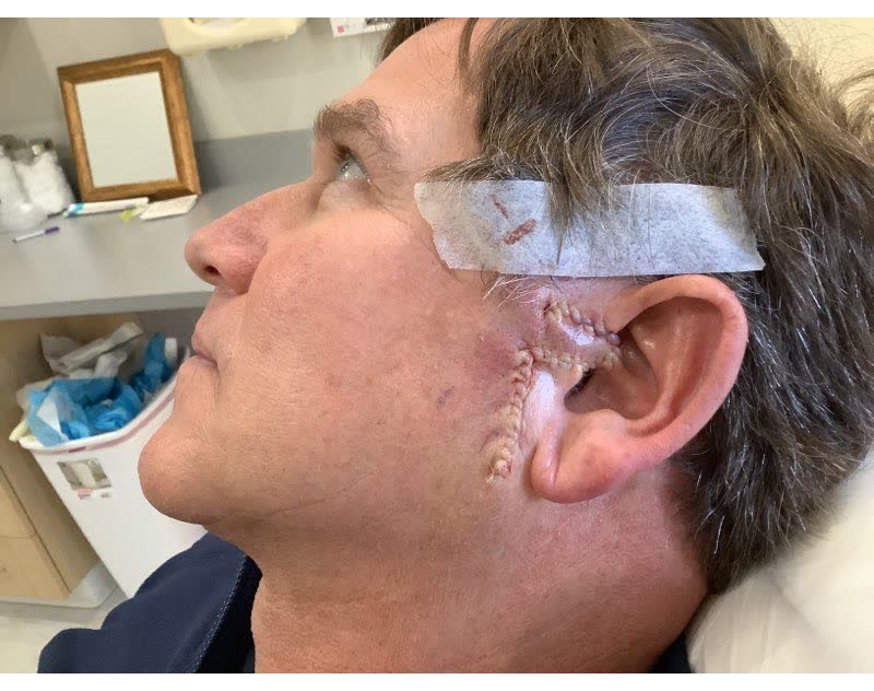 Mohs case 16 &mdash; Repair &middot; same day: basal cell carcinoma on the left ear and sideburn