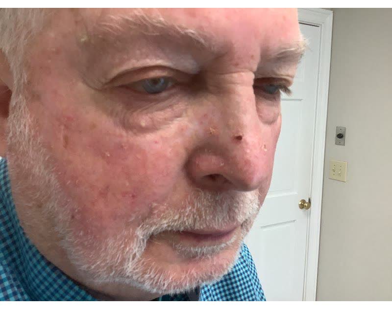 Mohs case 17 &mdash; Before: infiltrative basal cell carcinoma on the nose