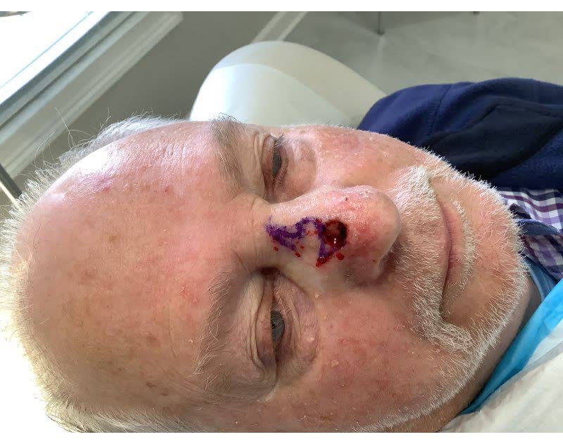 Mohs case 17 &mdash; After cancer removal: infiltrative basal cell carcinoma on the nose