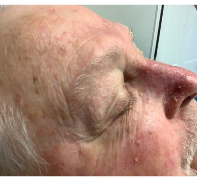Mohs case 17 &mdash; Healed: infiltrative basal cell carcinoma on the nose