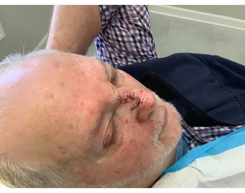Mohs case 17 &mdash; Repair &middot; same day: infiltrative basal cell carcinoma on the nose