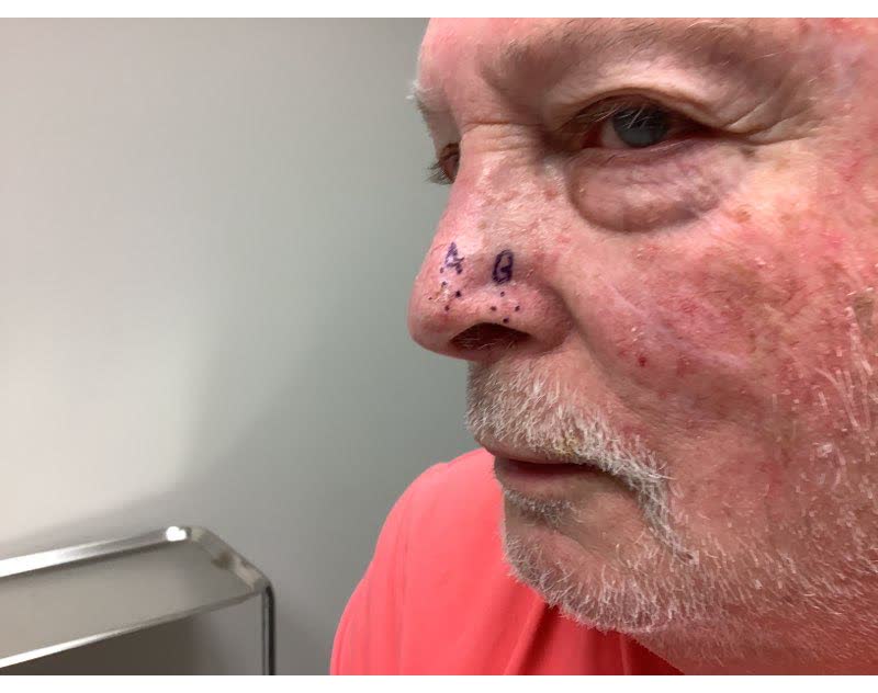 Mohs case 18 &mdash; Before: two basal cell carcinomas on the nose, including the alar rim