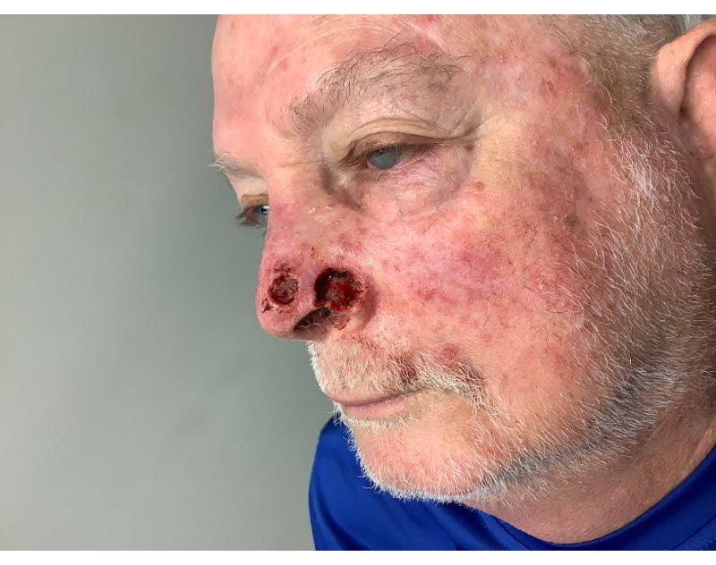 Mohs case 18 &mdash; After cancer removal: two basal cell carcinomas on the nose, including the alar rim