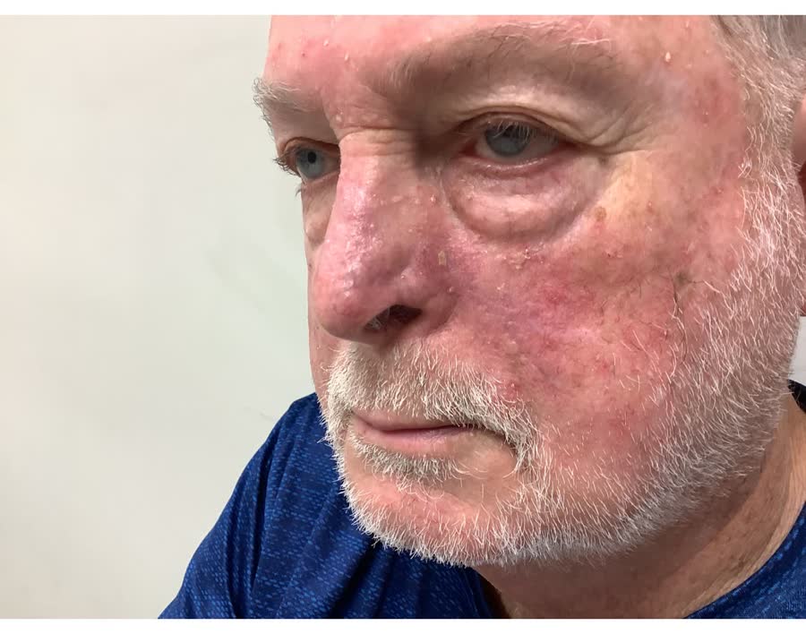 Mohs case 18 &mdash; Healed: two basal cell carcinomas on the nose, including the alar rim