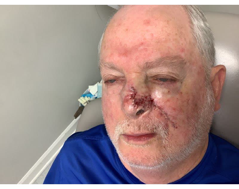 Mohs case 18 &mdash; Repair &middot; same day: two basal cell carcinomas on the nose, including the alar rim