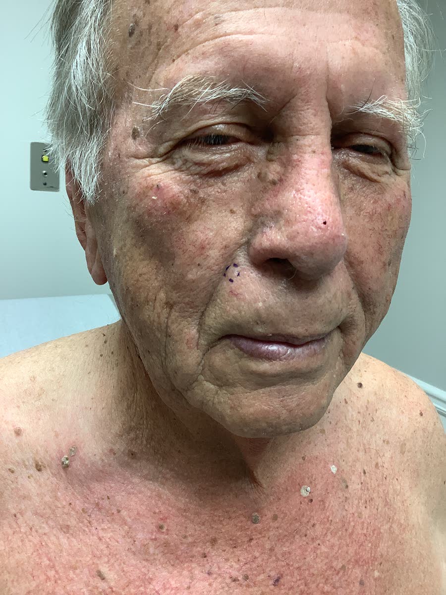 Mohs case 19 &mdash; Before: basal cell carcinoma on the right cheek