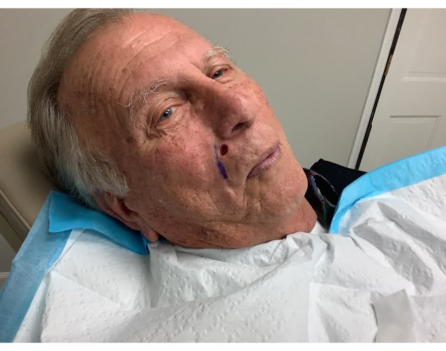 Mohs case 19 &mdash; After cancer removal: basal cell carcinoma on the right cheek
