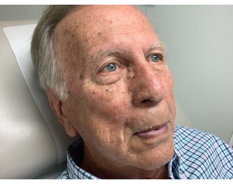 Mohs case 19 &mdash; Healed: basal cell carcinoma on the right cheek