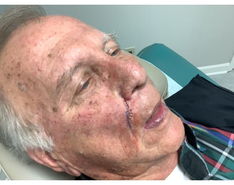 Mohs case 19 &mdash; Repair &middot; same day: basal cell carcinoma on the right cheek