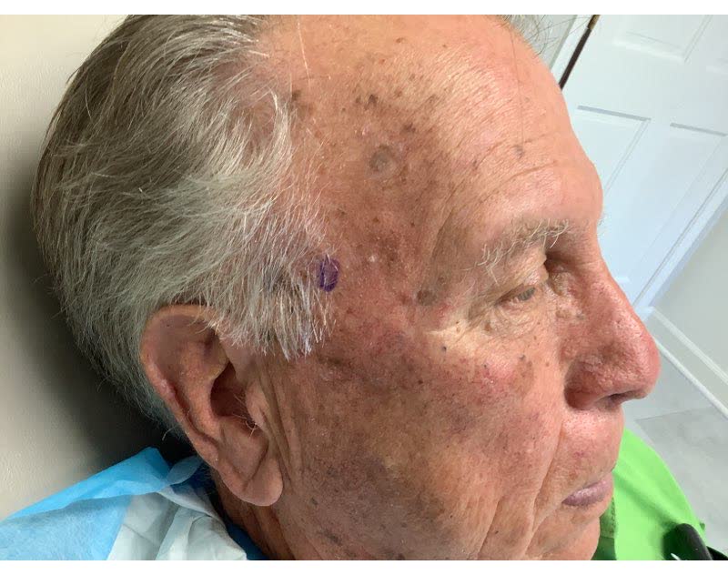 Mohs case 20 &mdash; Before: basosquamous carcinoma on the right temple