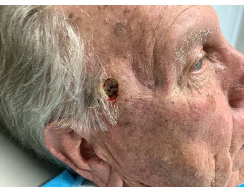 Mohs case 20 &mdash; After cancer removal: basosquamous carcinoma on the right temple