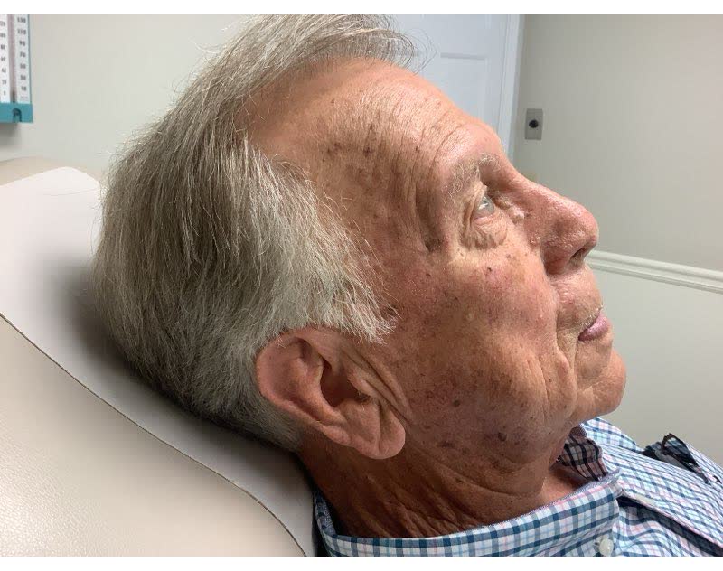 Mohs case 20 &mdash; Healed: basosquamous carcinoma on the right temple