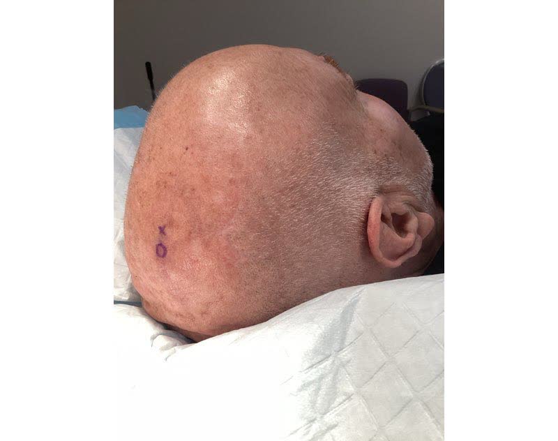 Mohs case 21 &mdash; Before: squamous cell carcinoma on the right scalp