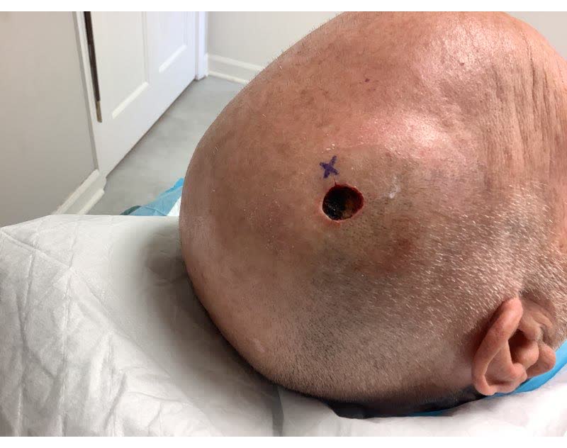 Mohs case 21 &mdash; After cancer removal: squamous cell carcinoma on the right scalp