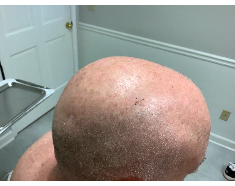 Mohs case 21 &mdash; Healed: squamous cell carcinoma on the right scalp