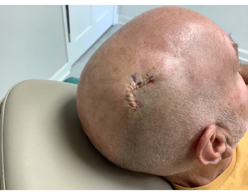 Mohs case 21 &mdash; Repair &middot; same day: squamous cell carcinoma on the right scalp