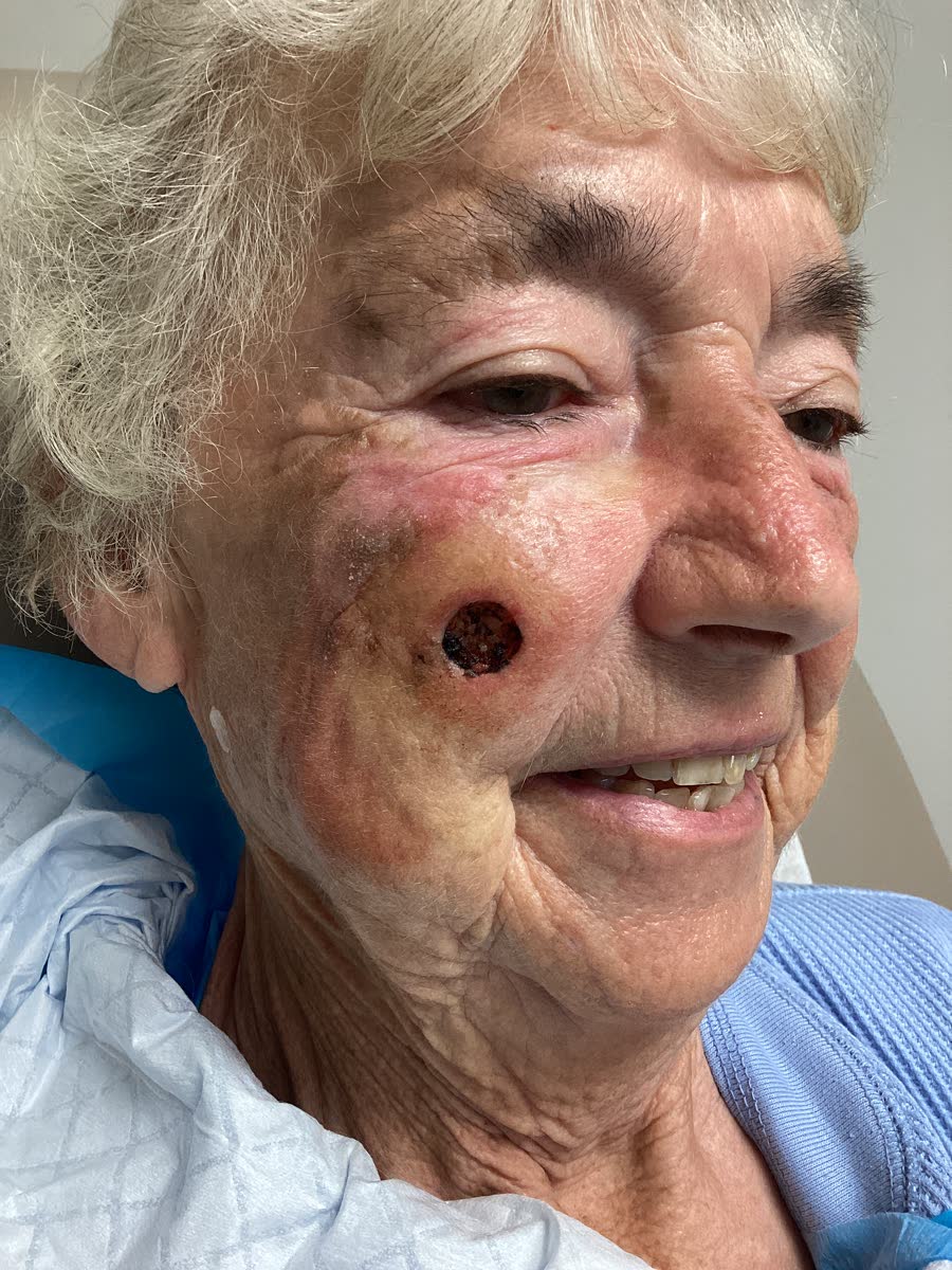 Mohs case 22 &mdash; Before: squamous cell carcinoma on the right cheek
