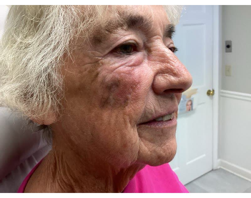Mohs case 22 &mdash; Healed: squamous cell carcinoma on the right cheek