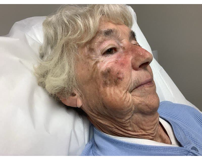 Mohs case 22 &mdash; About 1 week after surgery: squamous cell carcinoma on the right cheek