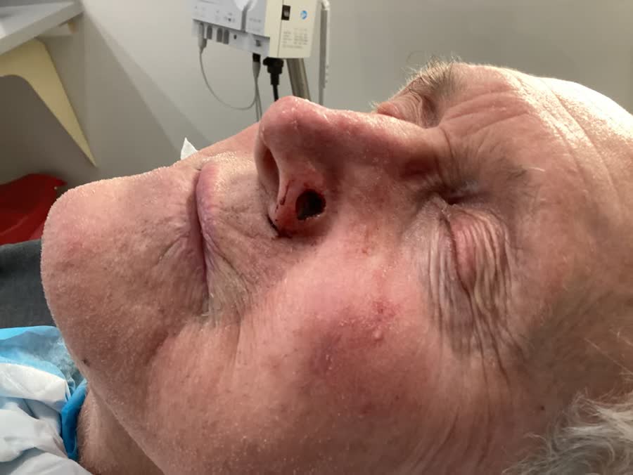 Mohs case 23 &mdash; After cancer removal: basal cell carcinoma on the nose repaired with a skin graft
