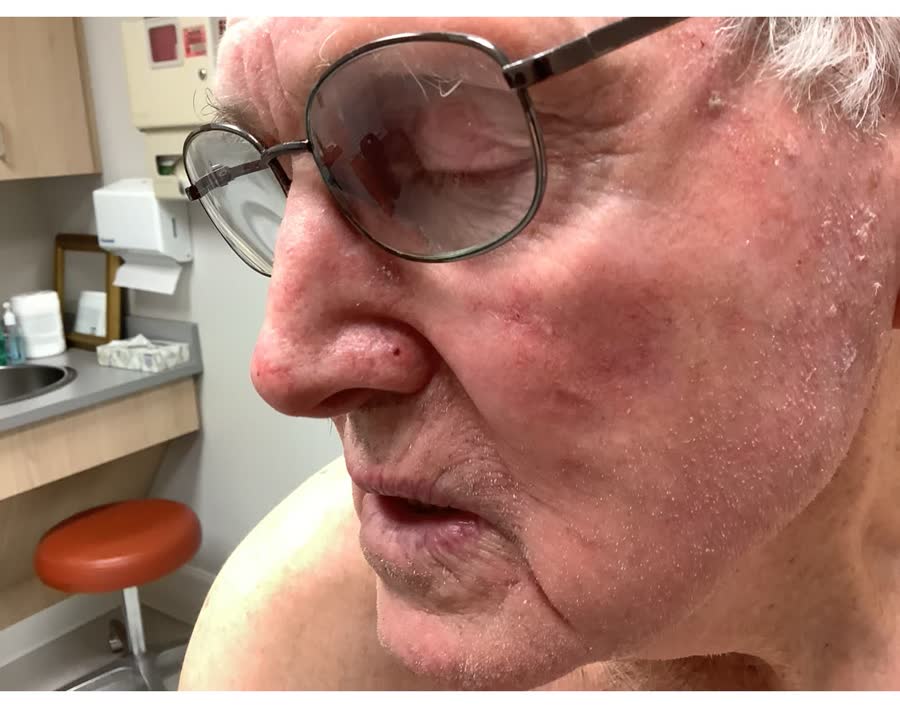 Mohs case 23 &mdash; Healed: basal cell carcinoma on the nose repaired with a skin graft