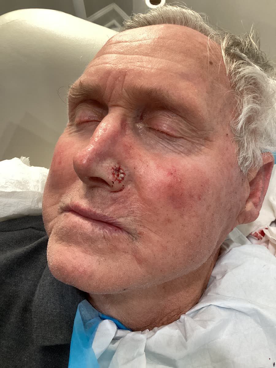 Mohs case 23 &mdash; Repair &middot; same day: basal cell carcinoma on the nose repaired with a skin graft